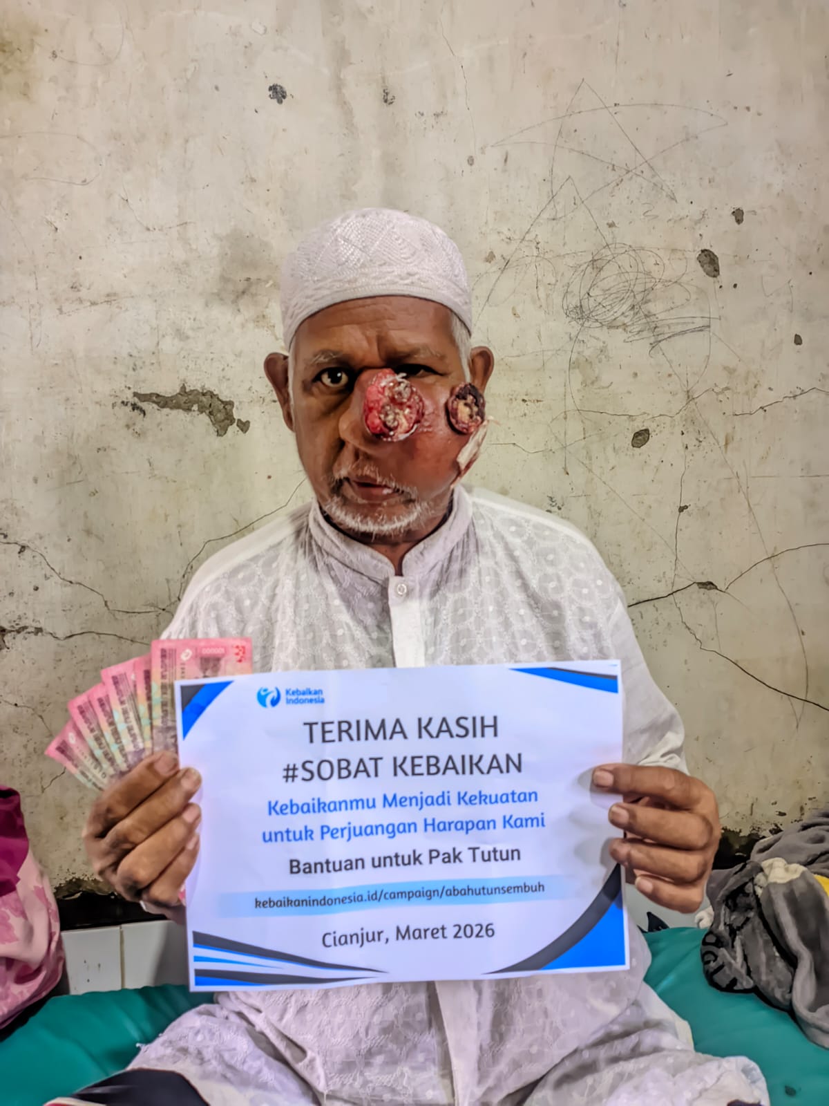 TOLONG! Pipi Digerogoti Tumor Ganas Hingga Membusuk, Bantu Abah Tutun Sembuh